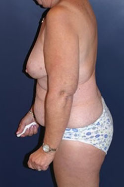 Breast Reconstruction Patient 50987 Photo 1