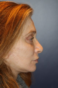 Facelift Patient 71182 Photo 4