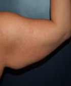 Arm Liposuction and Arm Brachioplasty Patient 15349 Photo 1