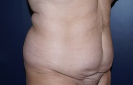 Tummy Tuck Patient 82205 Photo 3