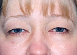 Eyelid Surgery Patient 43449 Photo 1