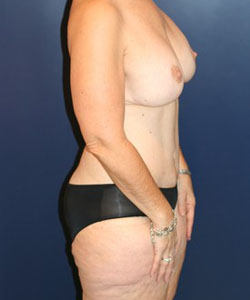 Massive Weight Loss Patient 70154 Photo 4
