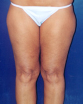 Liposculpture/Liposuction Patient 73218 Photo 3