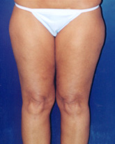 Liposculpture/Liposuction Patient 73218 Photo 3