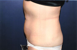 Liposculpture/Liposuction Patient 90722 Photo 4