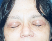 Eyelid Surgery Patient 17292 Photo 4