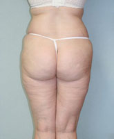 Liposculpture/Liposuction Patient 36058 Photo 4