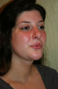 Chin Augmentation Patient 99366 Photo 2