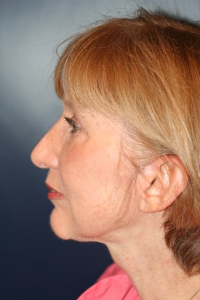 Chin Augmentation Patient 14849 Photo 4