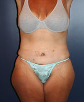 Tummy Tuck Patient 88019 Photo 2