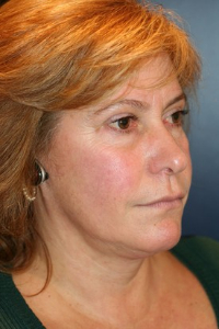 Brow Lift Patient 10471 Photo 3