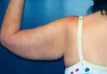 Arm Liposuction Patient 23064 Photo 1