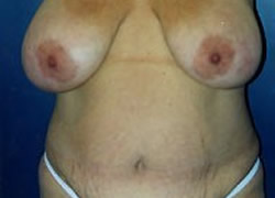 Breast Reduction Patient 50356 Photo 1