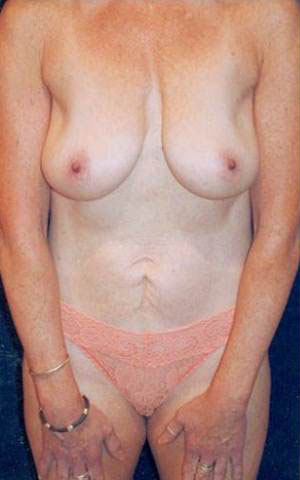 Tummy Tuck Patient 35295 Photo 3