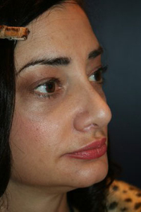 Rhinoplasty Patient 77758 Photo 4