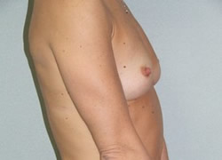 Breast Augmentation Patient 38051 Photo 3