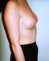 Breast Lift Patient 17522 Photo 2