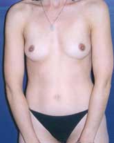 Breast Augmentation Patient 73703 Photo 1