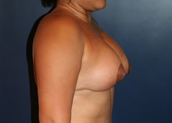 Breast Augmentation Patient 56638 Photo 2