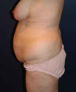 Tummy Tuck Patient 28531 Photo 1