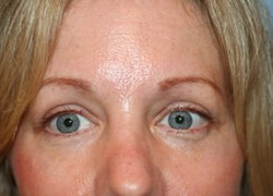 Eyelid Surgery Patient 21746 Photo 2