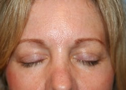 Eyelid Surgery Patient 21746 Photo 4