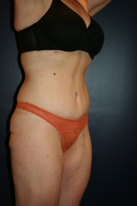 Massive Weight Loss Patient 79785 Photo 2