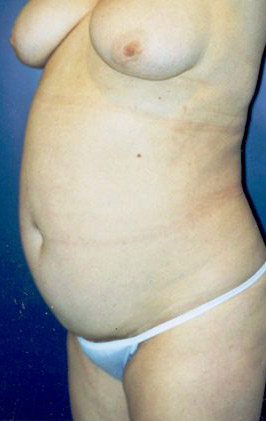 Tummy Tuck Patient 33040 Photo 3