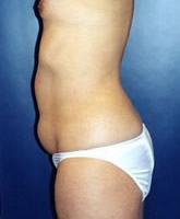 Liposculpture/Liposuction Patient 18798 Photo 3