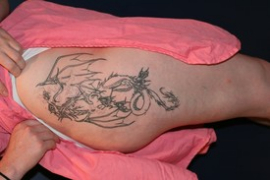 Tattoo Removal Patient 28810 Photo 1