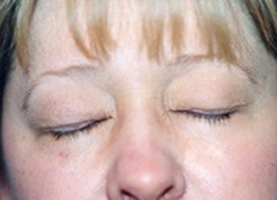 Eyelid Surgery Patient 43449 Photo 3