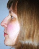 Rhinoplasty Patient 81440 Photo 1