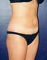 Liposculpture/Liposuction Patient 79741 Photo 4