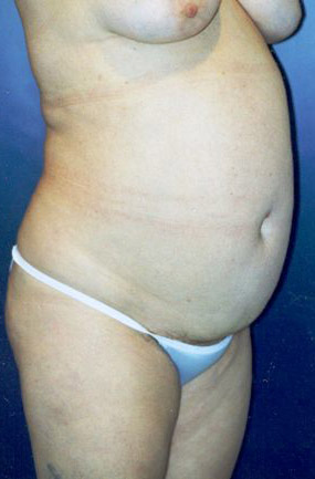 Tummy Tuck Patient 33040 Photo 5