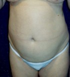 Tummy Tuck Patient 33040 Photo 1