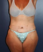 Massive Weight Loss Patient 11895 Photo 2