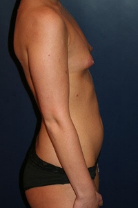 Breast Augmentation Patient 50093 Photo 3