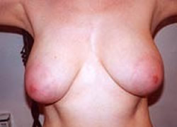 Breast Reduction Patient 14293 Photo 3