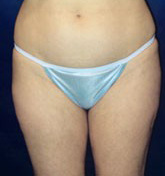 Liposculpture/Liposuction Patient 32081 Photo 2