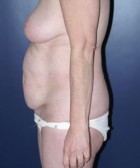 Liposculpture/Liposuction Patient 14094 Photo 1