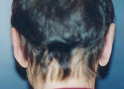 Otoplasty Patient 69674 Photo 4