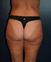 Breast Augmentation Patient 45539 Photo 4