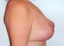 Breast Lift Patient 30639 Photo 2
