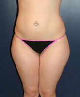 Liposculpture/Liposuction Patient 84406 Photo 3