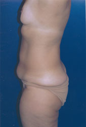 Breast Augmentation Patient 50635 Photo 3