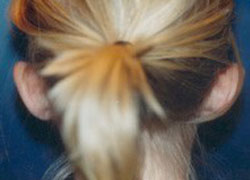Otoplasty Patient 84459 Photo 3
