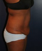 Tummy Tuck Patient 59616 Photo 1