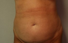 Tummy Tuck Patient 22755 Photo 1