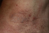 Tattoo Removal Patient 58196 Photo 4