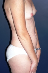 Breast Augmentation Patient 94717 Photo 3